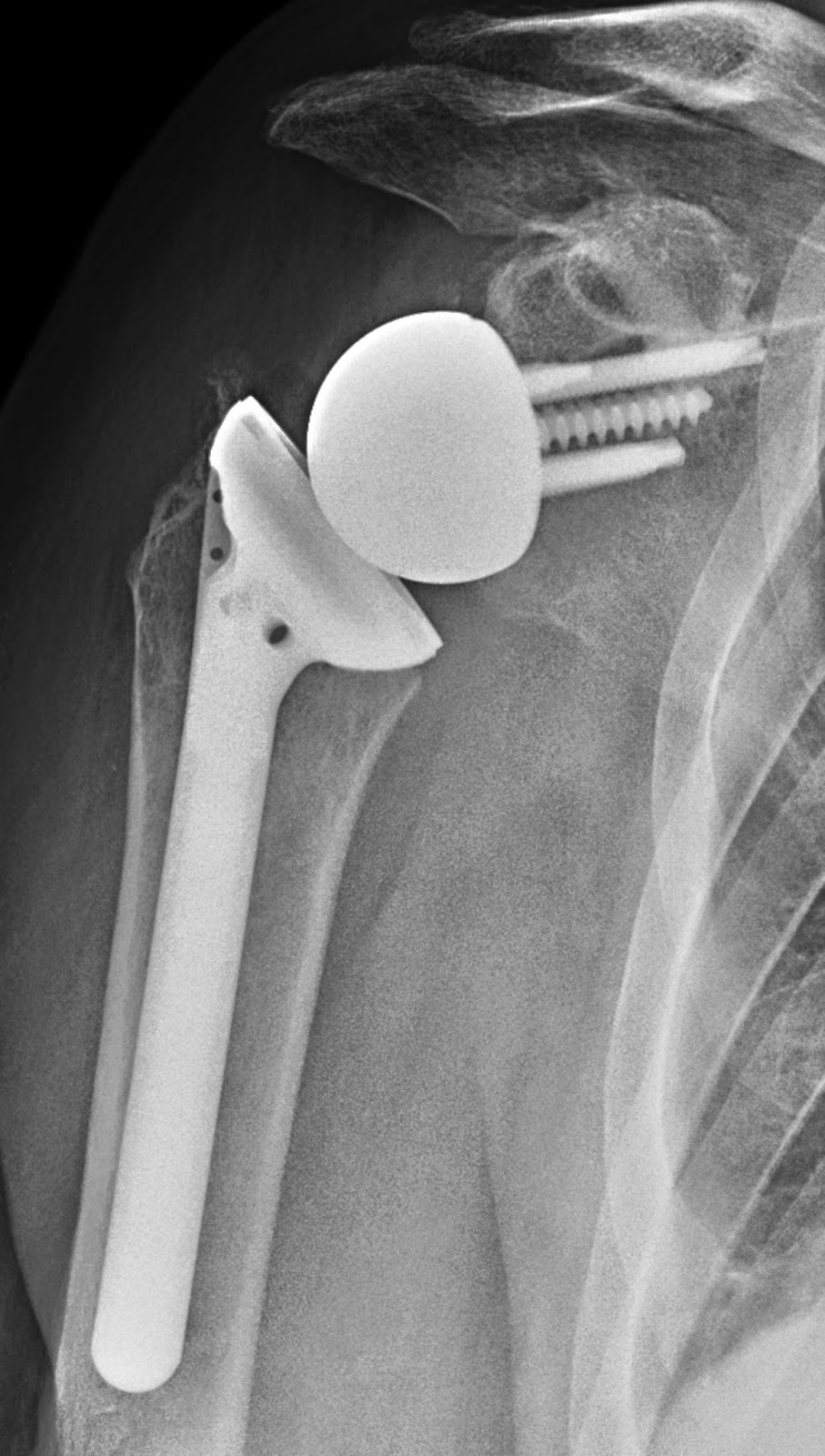 UW Shoulder and Elbow Academy Reverse total shoulder joint replacement
