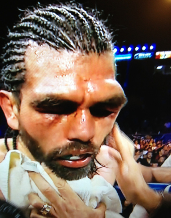 Boxer Alfredo Angulo's Broken Eye is Quite Something to Behold Bob's