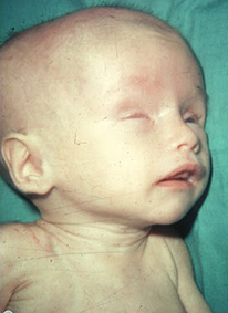 toxoplasmose risque bébé toxoplasmose risque bébé