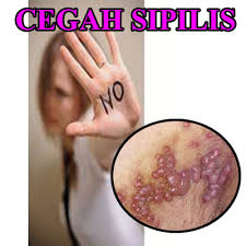 Nama Obat Herbal Untuk Penyakit Sipilis di Apotik