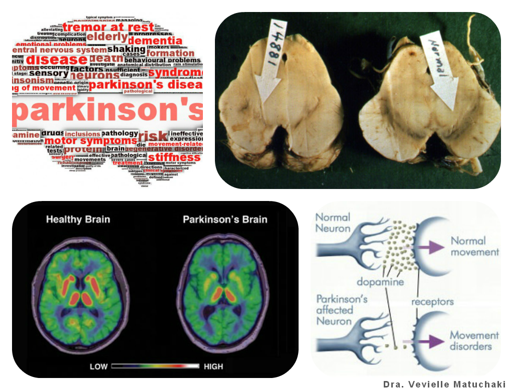 . Hora de uma pequena atualizaçãozinha sobre a Doença de Parkinson