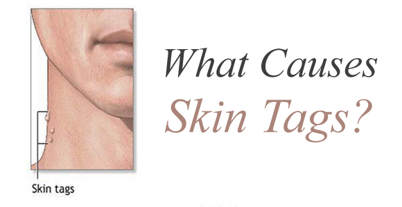 Skin Tag Causes and Treatments - Skin and Beauty Center ...