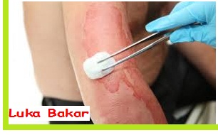 5 Cara Mengobati Luka Bakar Dengan Bahan Alami 5 Cara Mengobati Luka Bakar Dengan Bahan Alami