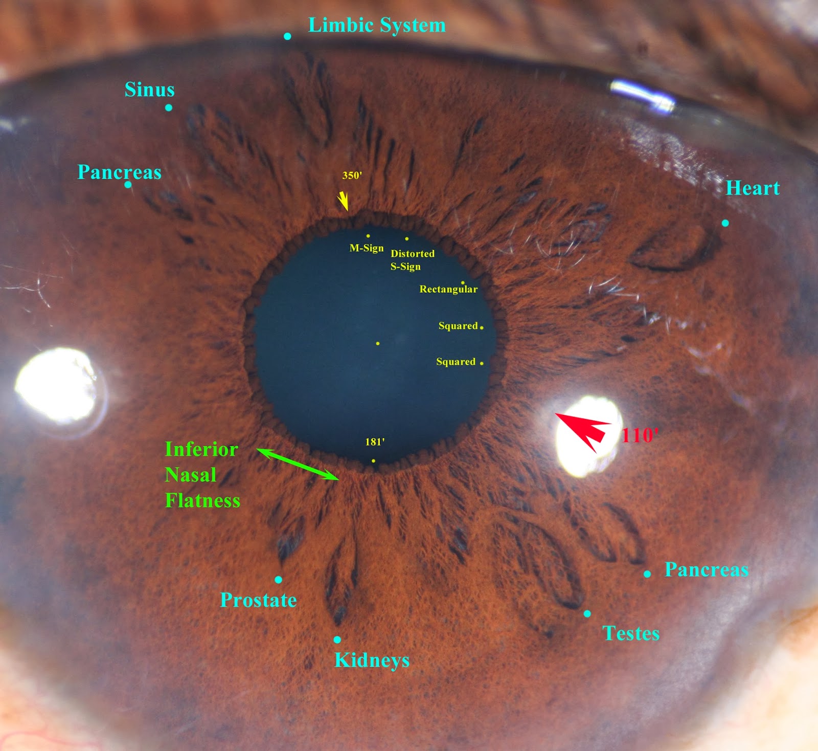 Modern & Multidimensional Iridology IPB Morphologies, Pupil