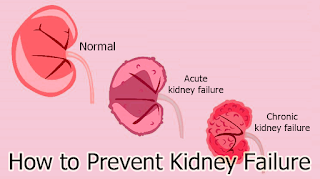 How to Prevent Kidney Failure