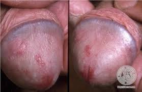 sipilis sipilis