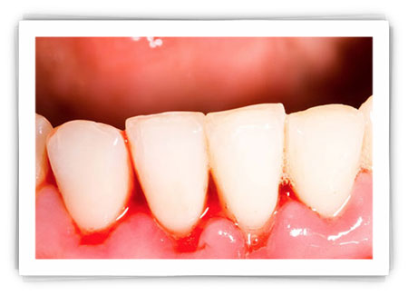 Reasons why your tooth gum bleeds Reasons why your tooth gum bleeds