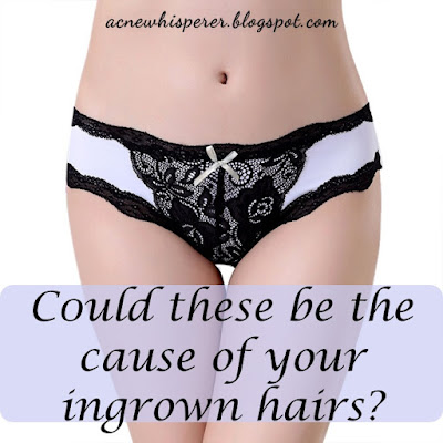 Can lace thong underwear be the cause of your bikini line and butt breakouts?