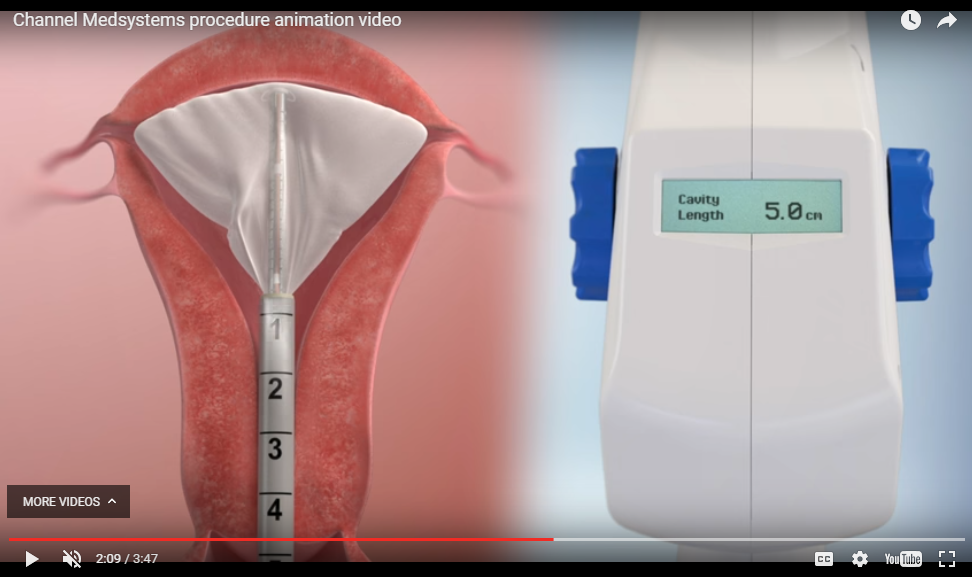 Ob/Gyn Updated Channel Medsystems completes pivotal study of Cerene
