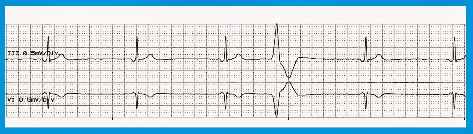 atropine on junctional escape rhythm atropine on junctional escape rhythm