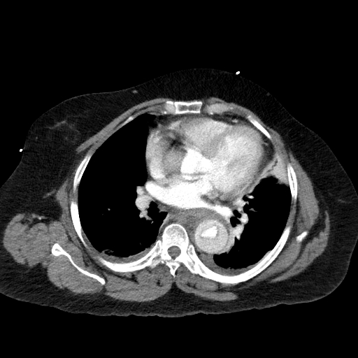 Dr. Smith's ECG Blog A Woman with 8 hours of Ongoing Crushing Chest