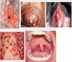 Sipilis