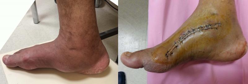 Charcot hastalığı, semptomları ve tedavisi Charcot hastalığı, semptomları ve tedavisi
