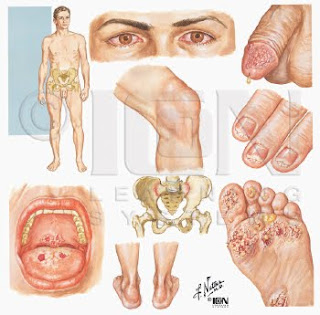 Obat Sipilis Antibiotik Obat Sipilis Antibiotik