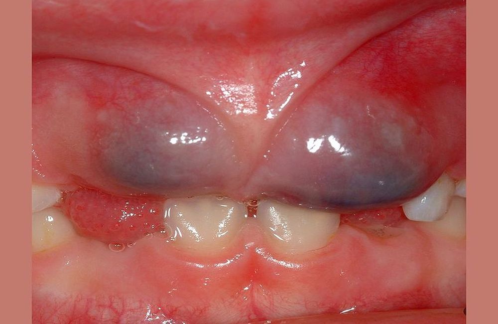 pediatric oral pathology odontogenic cysts odontobebe odontogenic cyst