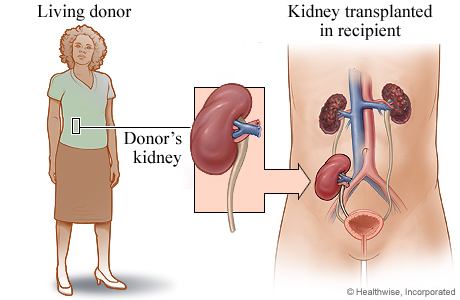 How Is a Kidney Transplant Performed?