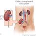 How Is a Kidney Transplant Performed?