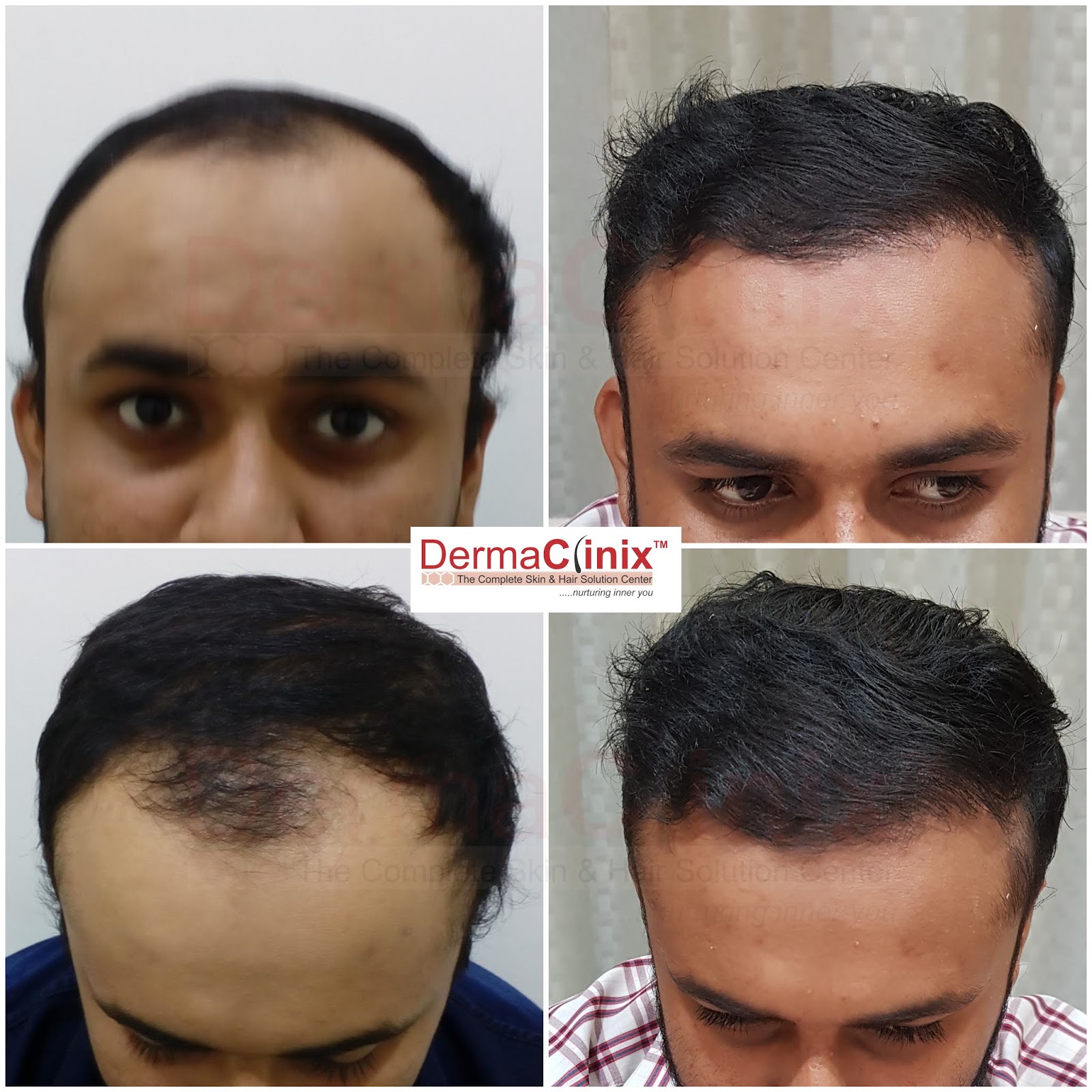 Hair Transplant Asia DermaClinix FUE Hair Transplant Process For