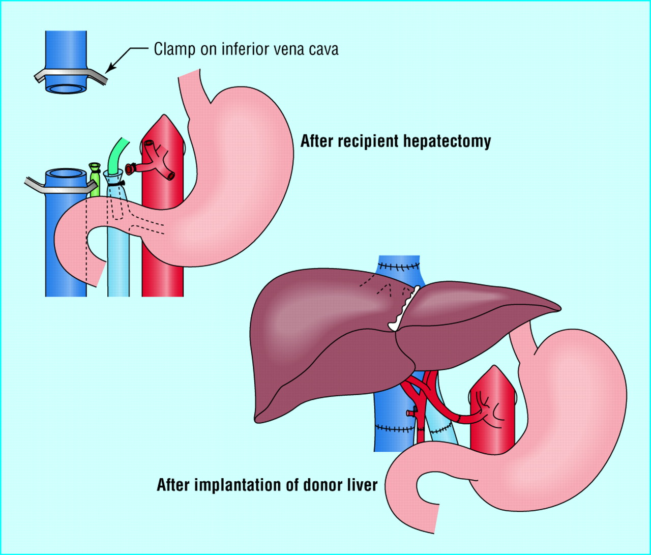 Liver Transplantation Surgery Whole deceased liver transplant...classical