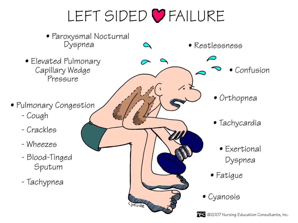 Symptoms of right sided heart failure vs left