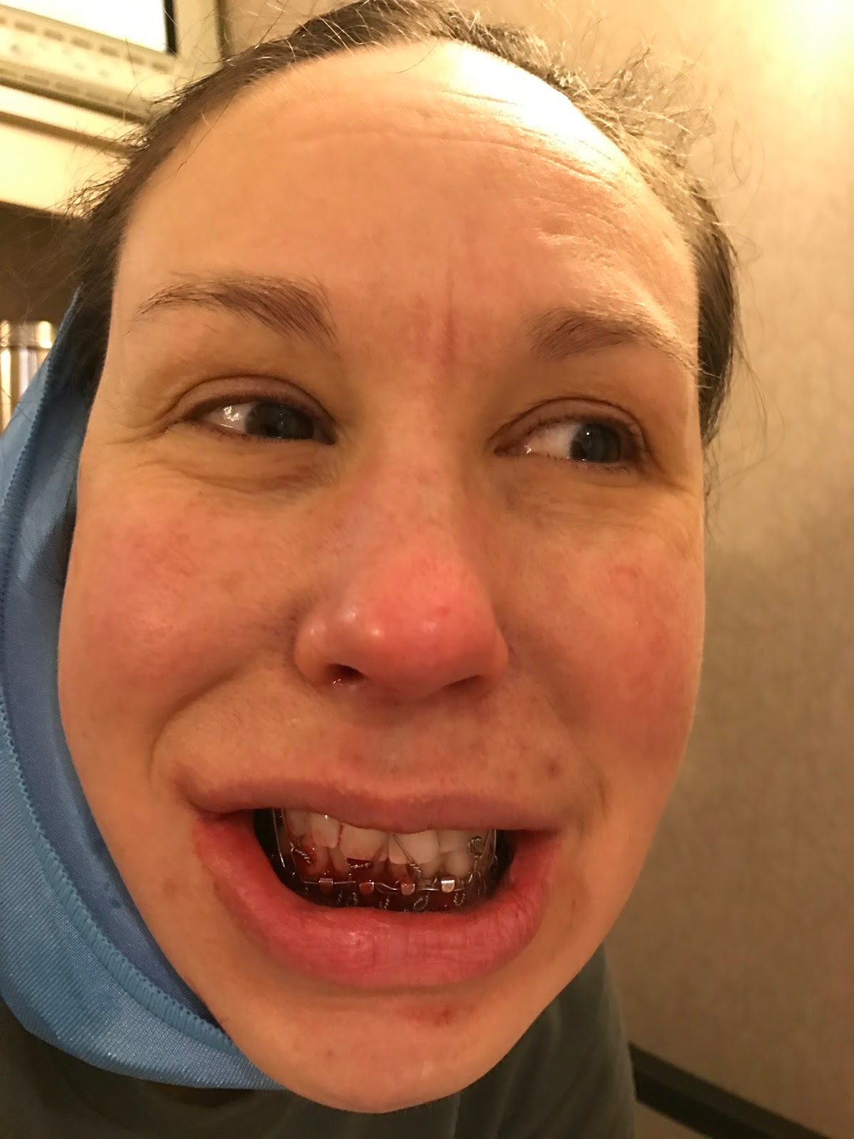 Cheyney and Ryan's Blog Intraoral vertical ramus osteotomy