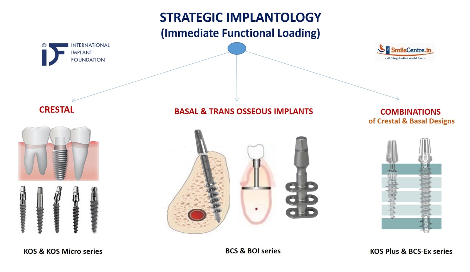 Strategic Implantology A boon for the Patient as well as the Doctor