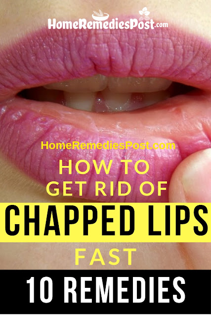 Chapped Lips, Dry Lips, How To Get Rid Of Chapped Lips, How To Get Rid Of Dry Lips, How To Cure Chapped Lips, Chapped Lips Remedy, Home Remedies For Chapped Lips, How To Treat Chapped Lips, Chapped Lips Treatment, Chapped Lips Home Remedies, Remedy For Chapped Lips, Cure Chapped Lips, 