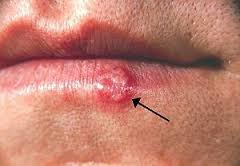 Image OBAT HERPES DARI BAHAN HERBAL