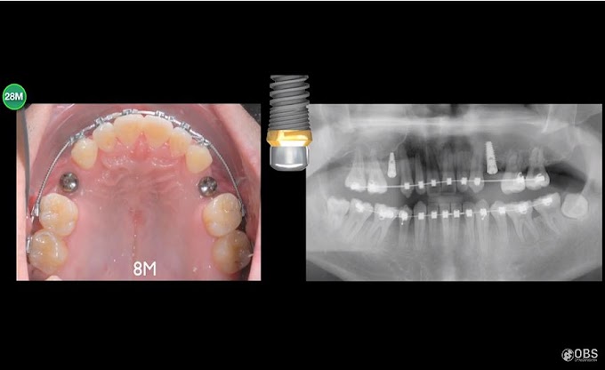 CLINICAL CASE: Ortho Implant Combined - Case Report by Dr. Huang