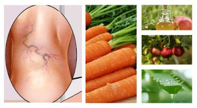 Quels sont les avantages de ce traitement naturel pour les varices Quels sont les avantages de ce traitement naturel pour les varices