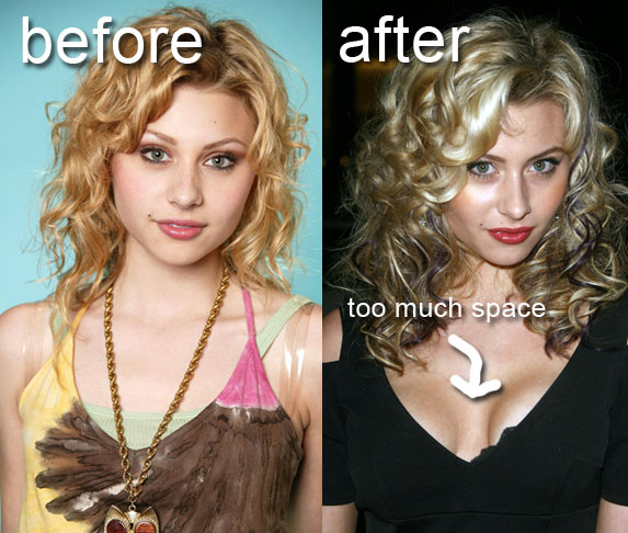 Breast Implants Before And After Pictures 120