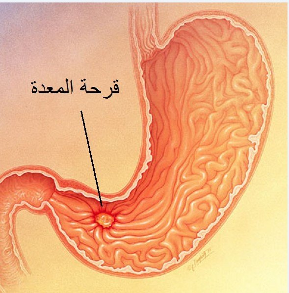 قرحة المعدة أسبابها وأعراضها وطرق علاجها