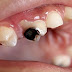 أسهل الطرق الطبيعية لعلاج تسوس الأسنان