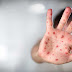 Saúde| Brasil tem 677 casos de sarampo confirmados, diz Ministério da Saúde