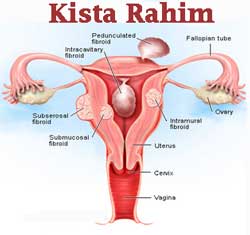 penyakit kista rahim kista