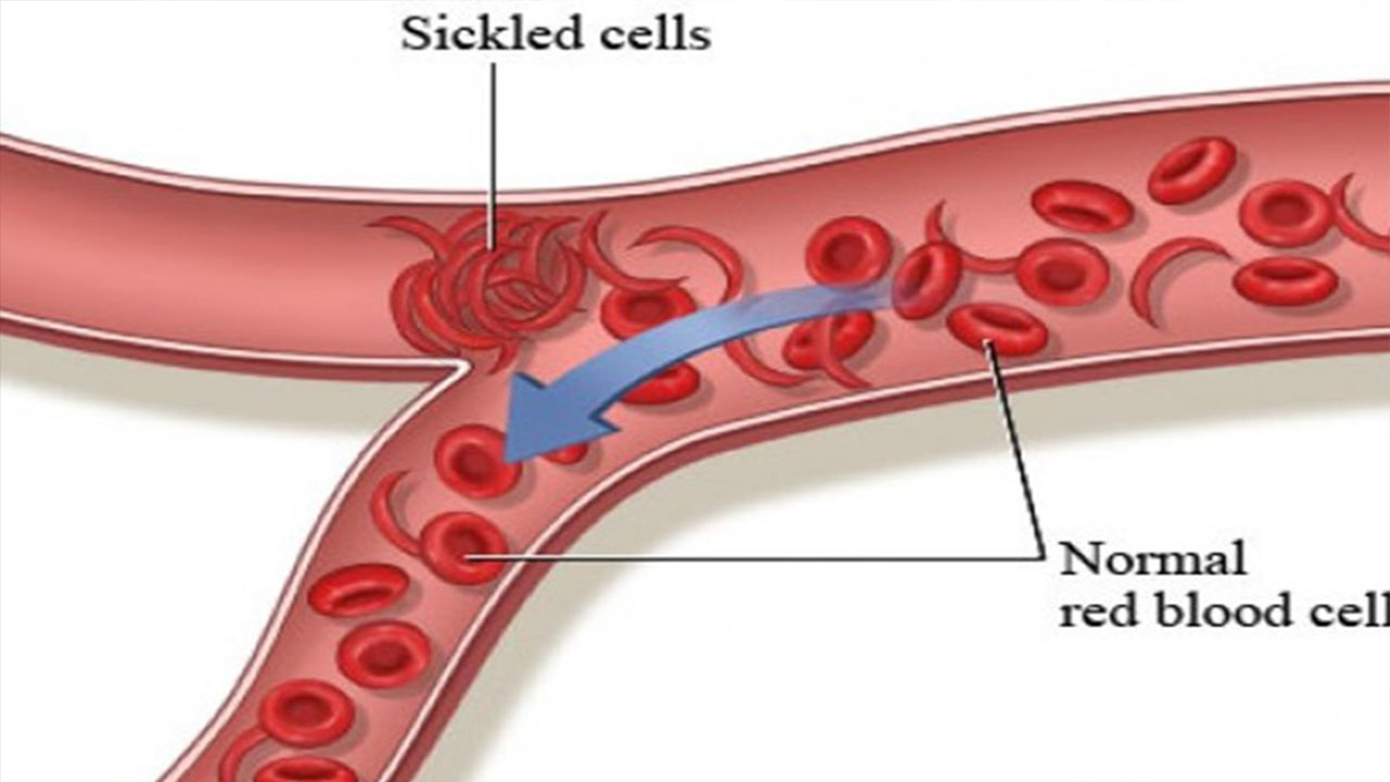 Anxiety caused by iron deficiency can have any symptoms?