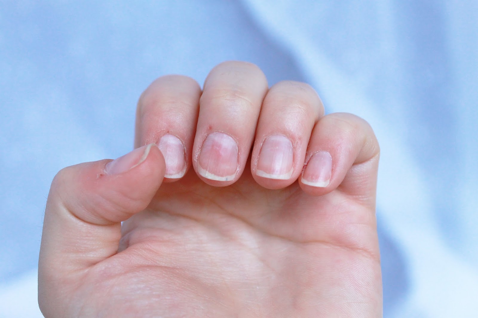 Micoza unghiilor - cauze, simptome si tratament
