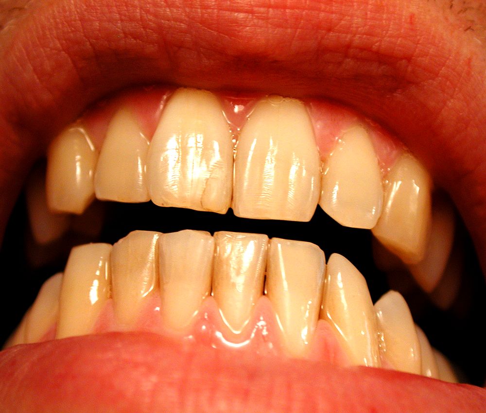 TEETH WHITENING How to Prevent Yellow Teeth (Without Whitening)