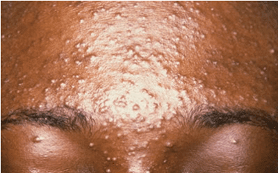 Say Goodbye to Pimples forever by following these 5 steps Say Goodbye to Pimples forever by following these 5 steps