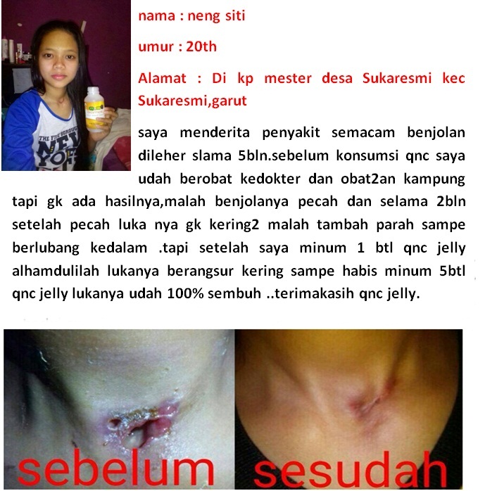 Cara Mengobati Benjolan Di Kaki Kanan dan Kiri Secara Alami Sampai Tuntas ~ TESTIMONI QNC JELLY GAMAT Cara Mengobati Benjolan Di Kaki Kanan dan Kiri Secara Alami Sampai Tuntas ~ TESTIMONI QNC JELLY GAMAT