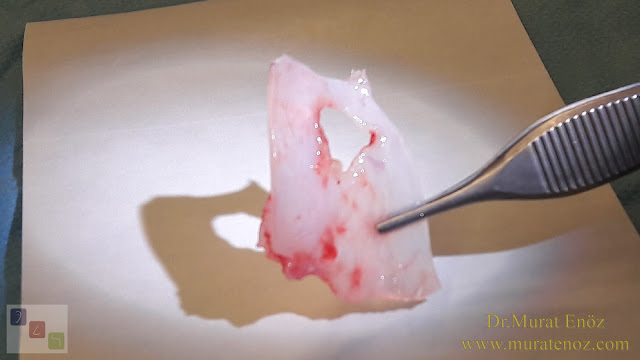 Ekstrakorporeal septum perforasyonu tamiri - Ekstrakorporeal septum perforasyonu ameliyatı - Septum perforasyonu tedavisi - Nazal septum perforasyonu operasyonu - Açık teknik ekstrakorporeal septum perforasyonu ameliyatı - Açık teknik ekstrakorporeal septum perforasyonu onarımı - Burun estetiği ile birlikte ekstrakorporeal septum perforasyonu kapatılması - Ekstrakorporeal burun septumunda delik kapatılması - Burunda delik oluşumu - Burun duvarında delik - Burun kıkırdak delinmesi tedavisi - Septum perforasyonu ameliyatı olanlar - Septum perforasyonu olanlar - Septal perforasyon tamiri - Ekstrakorporeal burun septum perforasyonu ameliyatı - Extracorporeal septum perforation closure in Istanbul - Extracorporeal septum perforation closure in Turkey - Extracorporeal closure of nasal septal perforations subcutaneous tissue - Combining rhinoplasty with extracorporeal septal perforation repair Ekstrakorporeal septum perforasyonu tamiri - Ekstrakorporeal septum perforasyonu ameliyatı - Septum perforasyonu tedavisi - Nazal septum perforasyonu operasyonu - Açık teknik ekstrakorporeal septum perforasyonu ameliyatı - Açık teknik ekstrakorporeal septum perforasyonu onarımı - Burun estetiği ile birlikte ekstrakorporeal septum perforasyonu kapatılması - Ekstrakorporeal burun septumunda delik kapatılması - Burunda delik oluşumu - Burun duvarında delik - Burun kıkırdak delinmesi tedavisi - Septum perforasyonu ameliyatı olanlar - Septum perforasyonu olanlar - Septal perforasyon tamiri - Ekstrakorporeal burun septum perforasyonu ameliyatı - Extracorporeal septum perforation closure in Istanbul - Extracorporeal septum perforation closure in Turkey - Extracorporeal closure of nasal septal perforations subcutaneous tissue - Combining rhinoplasty with extracorporeal septal perforation repair