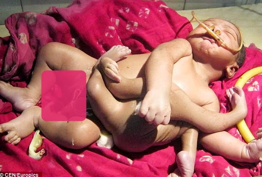 baby born 8 limbs india