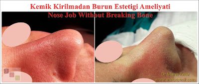 Rhinoplasty without breaking nasal bones - Nose job without breaking bone - Rhinoplasty without breaking bone - Nasal aesthetic surgery without breaking the nasal bone - Rhinoplasty in İstanbul, Turkey - Nose job in İstanbul, Turkey - Special offer for rhinoplasty without bone broken in İstanbul, Turkey Rhinoplasty without breaking nasal bones - Nose job without breaking bone - Rhinoplasty without breaking bone - Nasal aesthetic surgery without breaking the nasal bone - Rhinoplasty in İstanbul, Turkey - Nose job in İstanbul, Turkey - Special offer for rhinoplasty without bone broken in İstanbul, Turkey