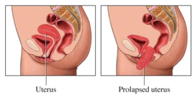 hình ảnh tử cung bình thường và sa tử cung