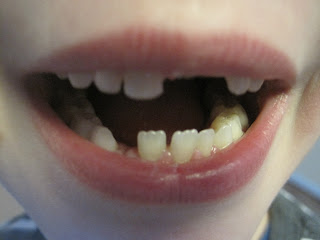 Mouth with gaps at top centre right and bottom left of centre.