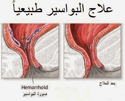 علاج البواسير