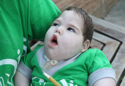 Bayi Ajaib Yang Lahir Dengan Kondisi Langka di Dunia Bayi Ajaib Yang Lahir Dengan Kondisi Langka di Dunia