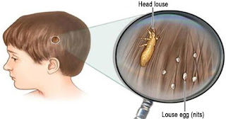 Get Rid Of Lice Easily And Cheaply