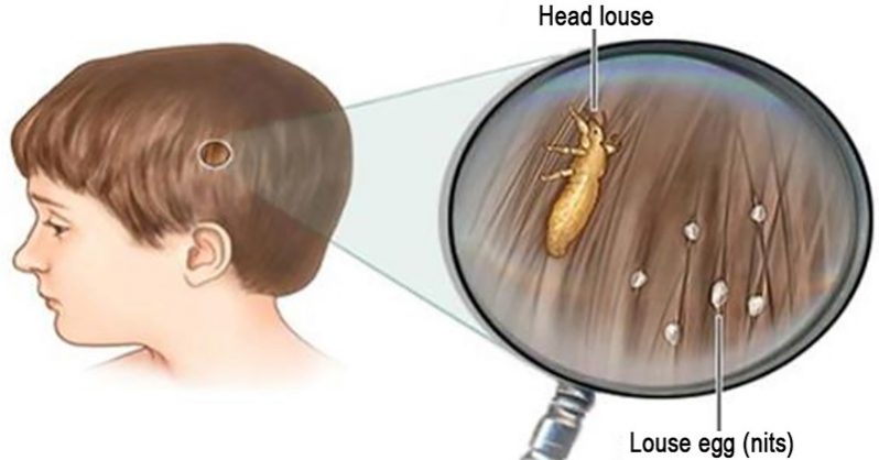 The Favorite Tip Of Grandmothers To Get Rid Of Lice Easily And Cheaply