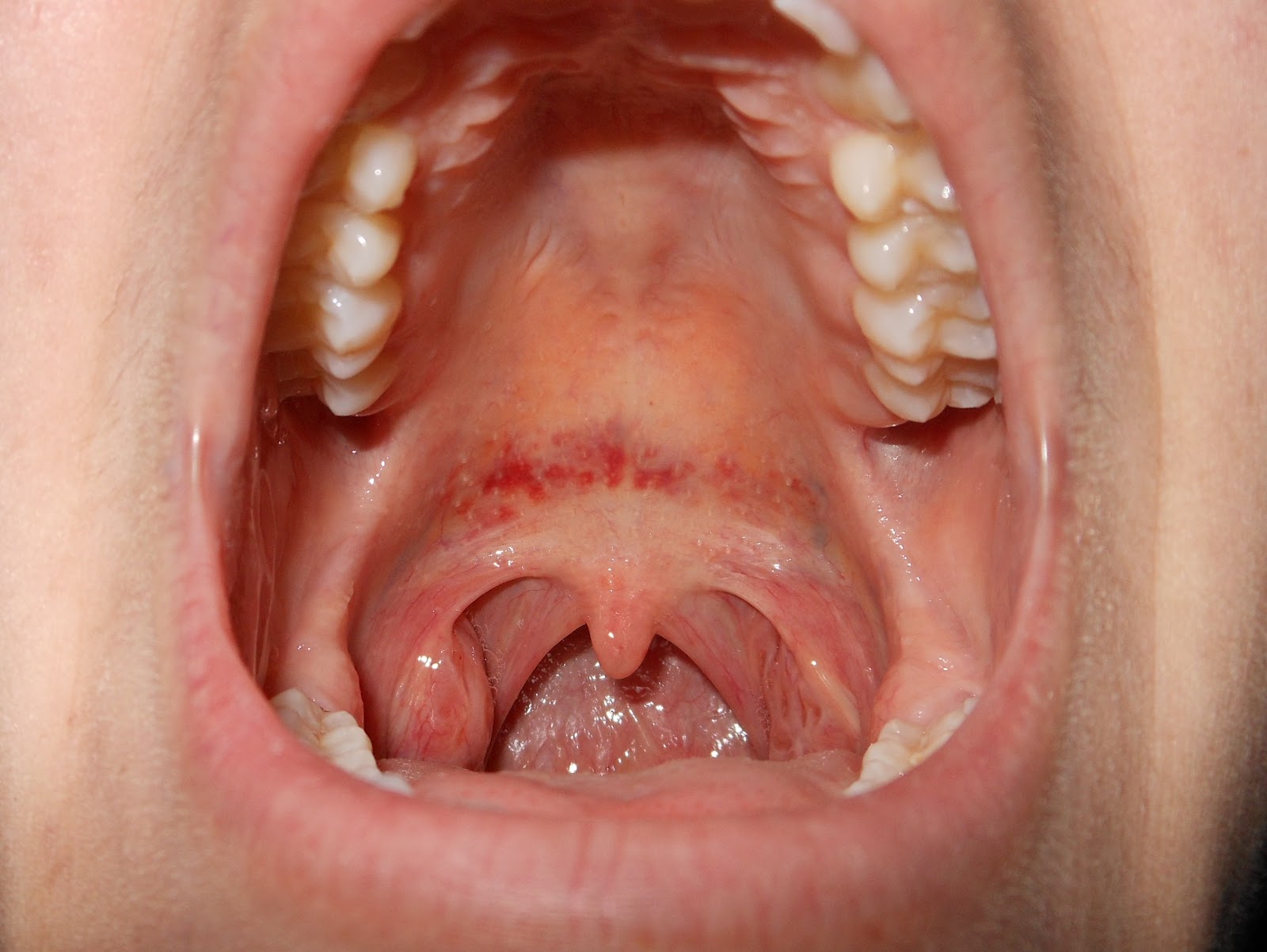 Rash Around Mouth (Lips) Causes, Pictures, Treatment ...